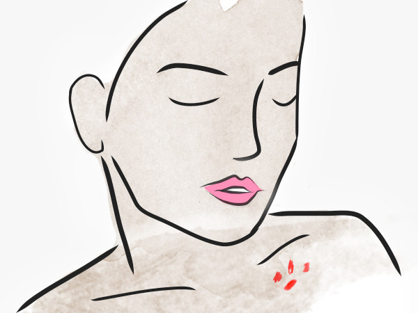 ESC, Keloids ESC, Keloids